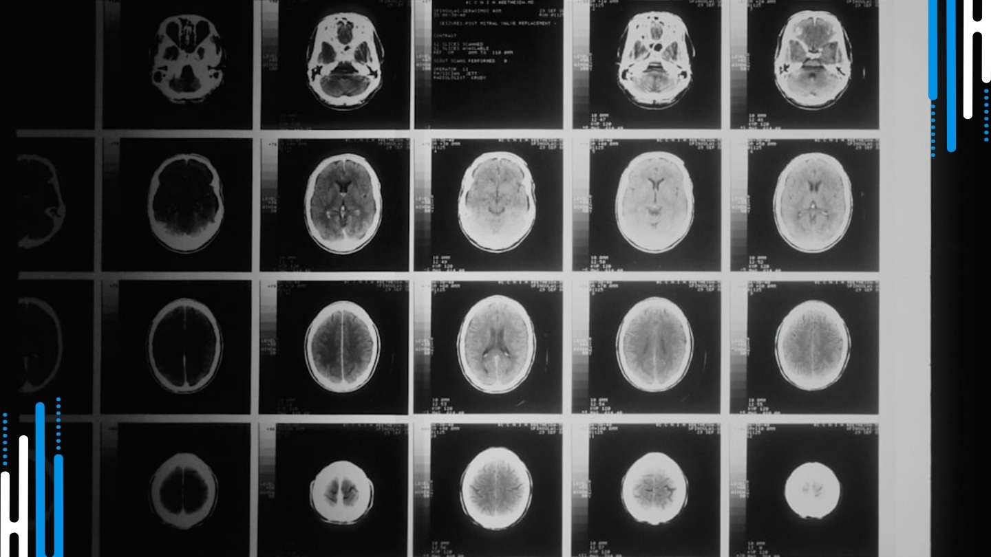 Benzodiazepine Tapering: Managing GABA-Receptor Damage & Withdrawal