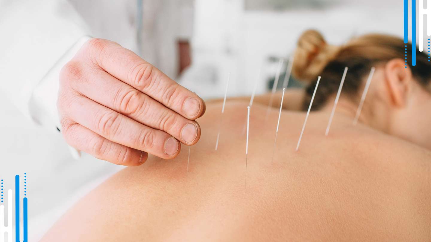 Acupuncture: A Stress Relief Solution for Anxiety